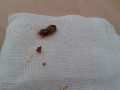 Right ear earwax 26 June 2019